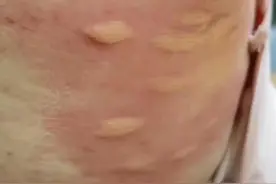 7月30日报道，疫情外溢！湖南疾控紧急提示！广东多地出现基孔肯雅热病例，请注意清积水，灭蚊虫，防叮咬。（编辑：廖一然）#基孔肯雅热 #传染病 #防蚊 #湖南dou知道