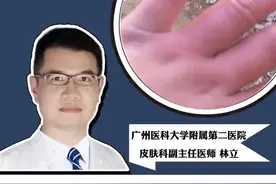 你有没有经历过长冻疮？你是怎么处理的？#科普 #医学科普#生活 #涨知识 #皮肤 视频封面