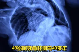 49岁大姐脊柱侧弯40多年，矫正后脊柱"拉长"10公分 #脊柱侧弯 #脊柱侧弯牵引 #北京大学第一医院王宇视频封面