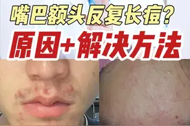 嘴巴额头疯狂长痘，该怎么解决？#痘痘 #痤疮 #科普 #抖出健康知识宝藏 #长痘的原因