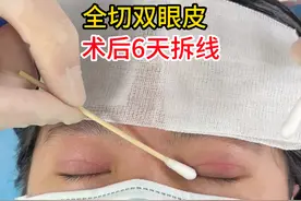 双眼皮术后6天拆线、拆线后注意事项。 #双眼皮 #变美那些事 #郑州双眼皮李朋杰 #双眼皮手术 #郑州双眼皮视频封面