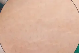 肥胖到皮肤裂开？腹型肥胖 满满的脂肪 肚皮全是肥胖纹#肥胖 #减重手术 #肥胖纹 #硬核健康科普行动  #健康视频封面