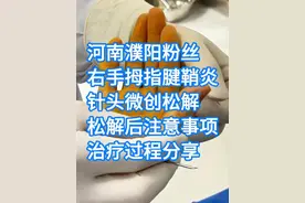 河南濮阳患者，右手拇指腱鞘炎，54岁，针头微创松解视频封面