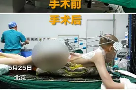 5月25日，北京，下午15点02分，“折叠男孩”首次手术成功！颈椎部位从反向折叠恢复近90度。后续他将佩戴头盆环继续矫正，为下次手术做准备！#折叠男孩的心愿视频封面