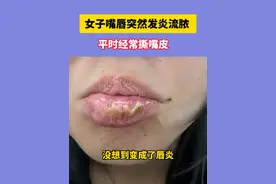 你也经常撕嘴皮吗？千万打住，医生教你正确去死皮#唇炎 #嘴巴干裂 #撕嘴皮 #唇部护理 #硬核健康科普行动视频封面