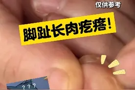 长#鸡眼 走路痛！医生手把手教你三步处理，温和又简单~#科普 #皮肤 #简单易学