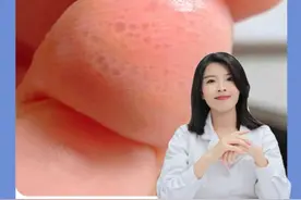 手上长小水泡特别痒，反反复复折磨人！医生教你正确处理减少反复#汗疱疹  #小水泡  #痒  #听医生一句劝  #硬核健康科普行动