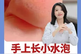 手上长小水泡特别痒，反反复复折磨人！医生教你正确处理减少反复#汗疱疹  #小水泡  #痒  #听医生一句劝  #硬核健康科普行动视频封面