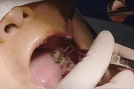 牙齿有个大窟窿，堆积食物残渣易发炎 #口腔科普 #牙齿🦷 #龋齿 #美中宜和口腔科视频封面