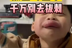 外出玩耍，#孩子 不小心被#蜜蜂 蛰，千万别直接上手拔#蜜蜂蛰伤 #健康科普视频封面