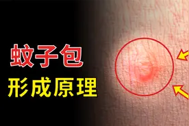 为什么有的人被蚊子咬了鼓大包，有的却是一个小红点？