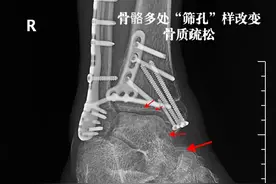 手术做挺好，患者脚脖僵了！这算恢复的好还是不好？图片