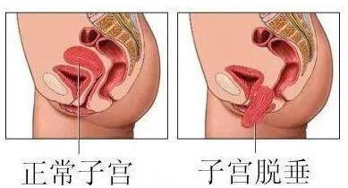 什么是直肠脱垂？如何分度？如何诊断及鉴别诊断？ 一