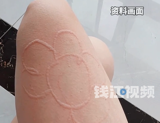 女子得了荨麻疹直接在皮肤上划字