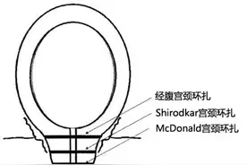 孕中期的宫颈环扎术是什么？图片