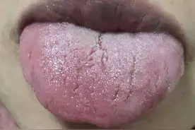舌头火辣辣的是什么原因引起的？ 舌头有被灼烧感觉图片