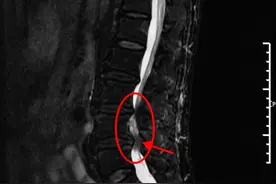 腰突做核磁提示“马尾冗余征”的时候，您可别忽视。 ...图片