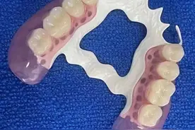 拔完牙后，做什么假牙# 这是许多患者关心的问题图片