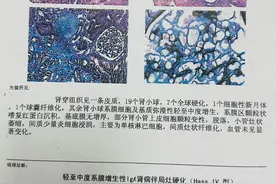 22年的IgA肾病没有发生肾衰，他是怎么做到的？图片
