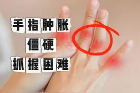手指肿胀、僵硬、抓握困难，这是风湿吗？图片