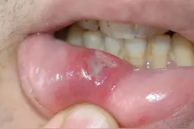口腔溃疡是什么原因引起的 口腔溃疡是什么原因引起的？图片