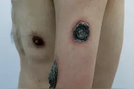 一般的梅毒都是比较容易治疗的图片