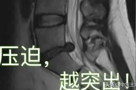 腰椎间盘突出根源其实不在腰，问题出在这里图片