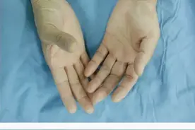 55岁大姐，经常晚上睡觉感觉手指麻木，不舒服图片