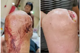 糖尿病足患者的脚很酸臭，洗干净后家属却意见很大图片