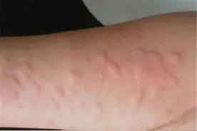 应粉丝要求，讲一下血热 关于这个血热图片