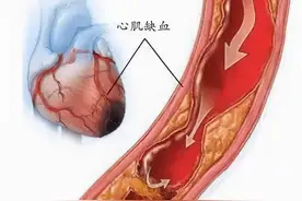 心肌缺血四大症状，希望你都没有】 大家好图片