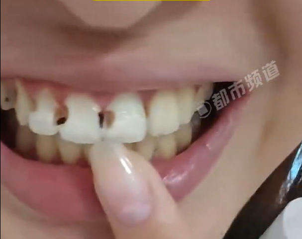 女子戴牙套5年坏了8颗牙