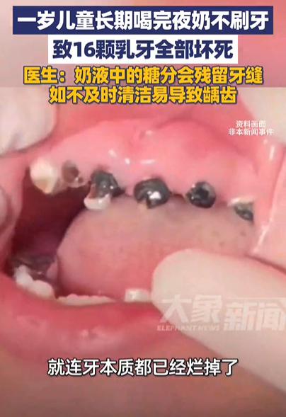 孩子喝夜奶后口腔需要清洁吗