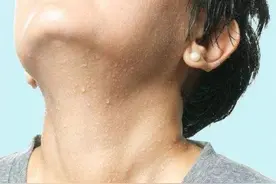 阴虚盗汗，气虚自汗，湿热汗黏，中医教你正确止汗图片