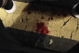 骨折之后怎么办？聊一聊骨折的亲身经历图片