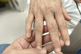 正处于50多岁的女性朋友们，您的手指有这种小结节吗？图片