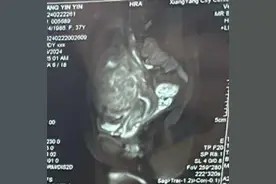 今天早晨咨询的一个子宫肌瘤案例值得科普，37岁，2次顺...图片