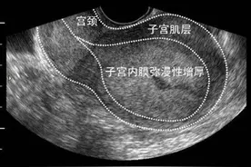 子宫内膜炎———女人难言的痛！今天就把“子宫内膜炎图片