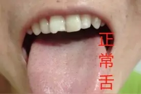 湿热，同样是黄舌苔，用药却完全不一样图片