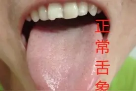 湿热，同样是黄舌苔，用药却完全不一样图片