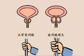 7个中成药解决前列腺增生，让您排尿顺畅没烦恼图片