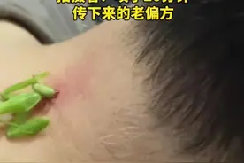 惊人真实：螳螂“大夫”如何用昆虫术神奇治愈颈部瘊子...图片