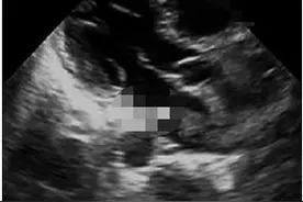 37岁女子洗澡时，摸到外阴有个水泡，医生：不是怀孕，是癌症图片