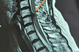 为什么片子看颈椎间盘突出很重，但自觉症状挺轻？图片