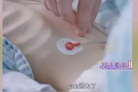 25岁女孩腹部抽脂，永久丧失生育能力，网友毁三观：还有这好事？图片