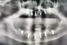 本人全口种植牙个人感受（二） 这是第二次拔上颚牙齿...图片