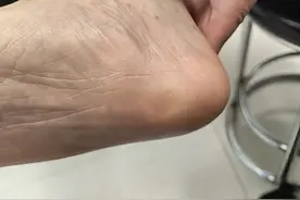 脚后跟疼，早上不敢落脚，到底是为啥？该咋办？医生告诉您图片