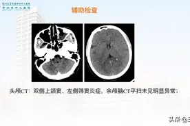 又一 “颈部疼痛按摩后头晕” —椎动脉夹层致延髓梗死的溶栓治疗。图片