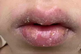 李女士今年28岁了，最近一年嘴唇反复出现干燥图片