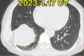 多么好的年纪，  首次发现肺癌即7.7cm×6图片